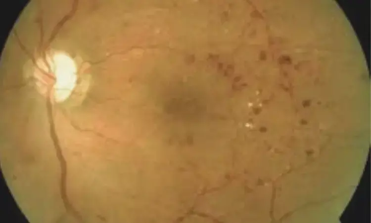 Choriocapillaris flow deficit tied to disease duration in type 2 diabetic patients without retinopathy