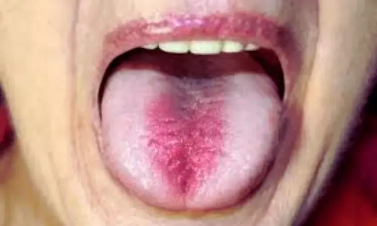 Higher salivary opiorphin concentrations linked to Burning Mouth Syndrome