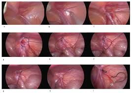 Single Incision Laparoscopic Totally Preperitoneal Hernioplasty Safe