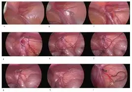 Single incision laparoscopic totally preperitoneal hernioplasty safe and feasible for treating bilateral inguinal hernias, unravels study