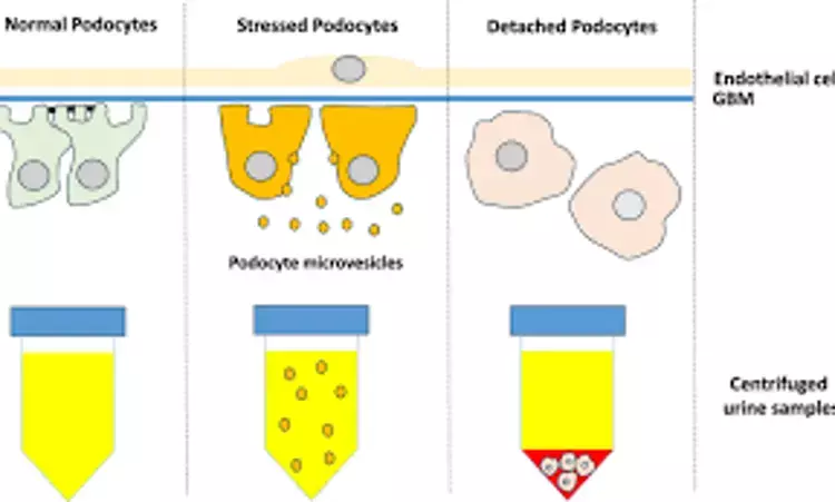 Urinary sediment messenger RNA  potent biomarker of IgA nephropathy, claims study