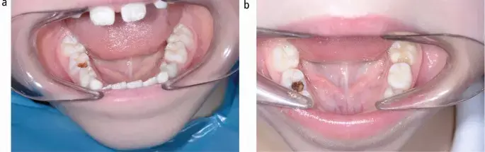 Silver diamine fluoride faster and less invasive alternative to ART for treatment of caries lesions: Study