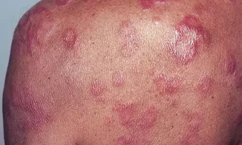 Bedaquiline Monotherapy for Multibacillary Leprosy Bedaquiline Monotherapy for Multibacillary Leprosy