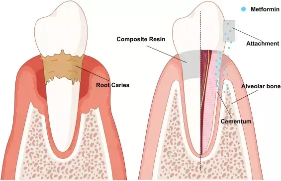 New metformin-resin promising for  restoration of tooth root caries and  regeneration of periodontal tissues: Study