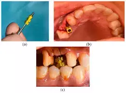 Coded implant abutments may enhance digital fabrication of fixed implant prostheses and reduce chair time: Study Coded implant abutments may enhance digital fabrication of fixed implant prostheses and reduce chair time: Study