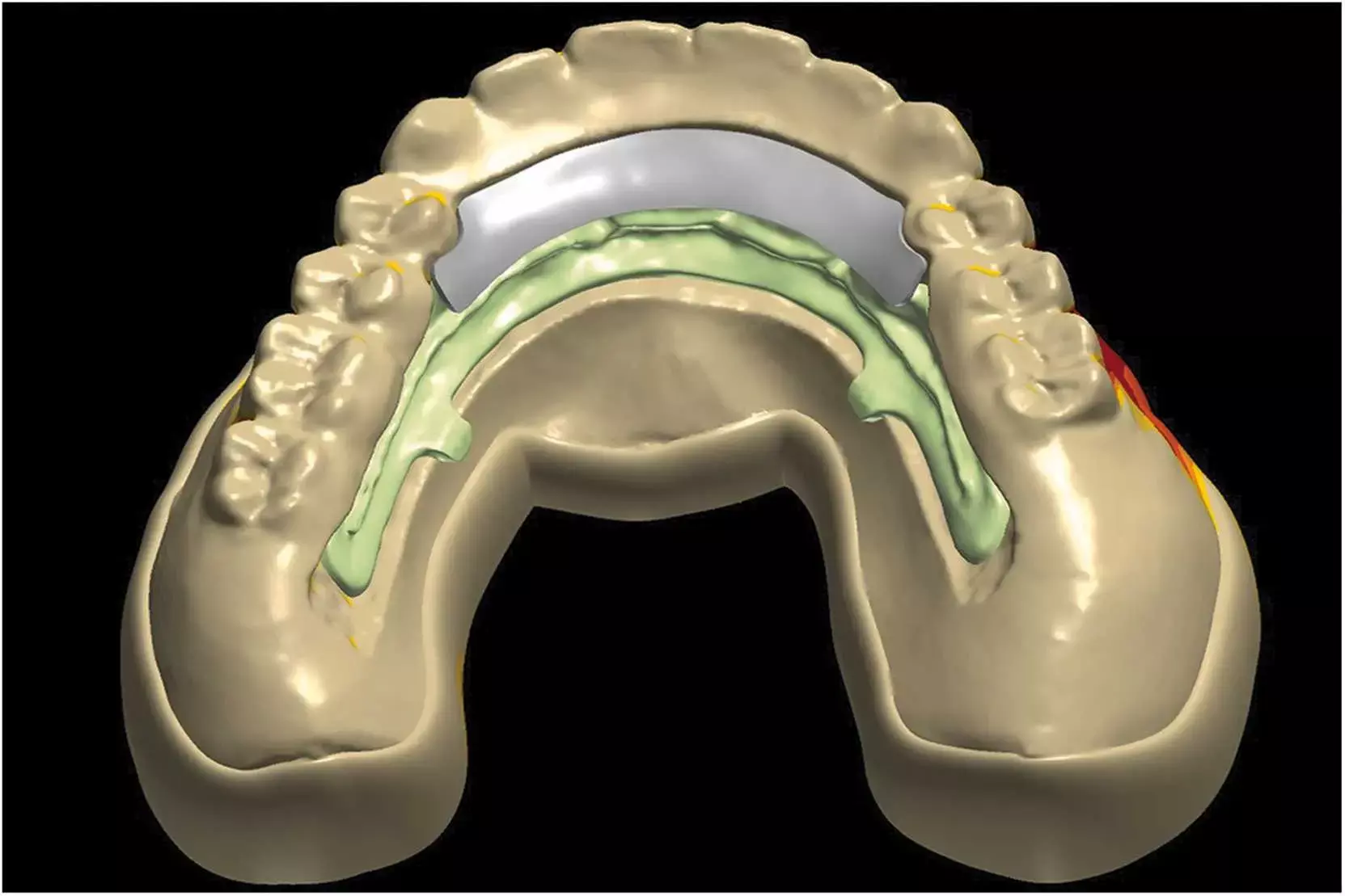 Implementing Digital Workflow for fabrication of Implant Supported Overdentures reduces cost: Study Implementing Digital Workflow for fabrication of Implant Supported Overdentures reduces cost: Study