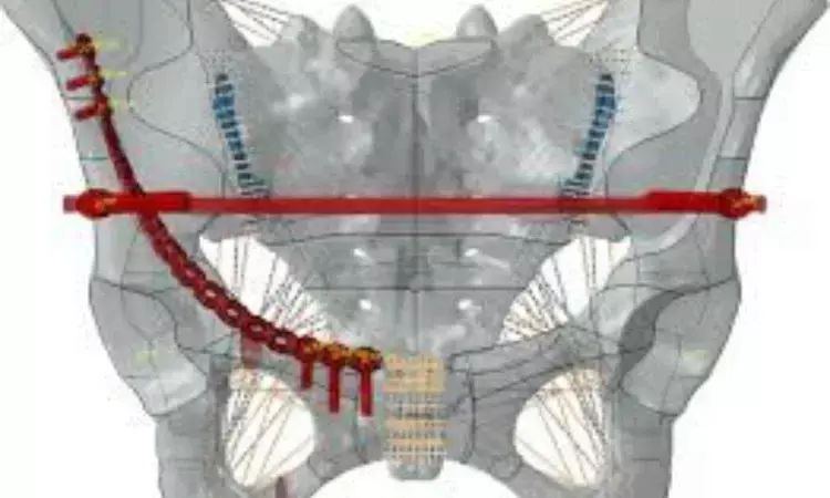 Screw-rod system safe,minimally invasive technique for posterior pelvic fracture, suggests study