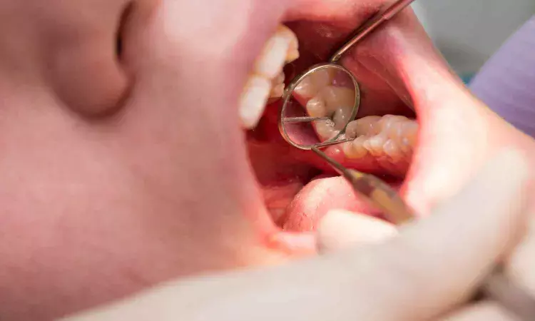 Silver diamine fluoride faster and less invasive alternative to ART for treatment of caries lesions: Study