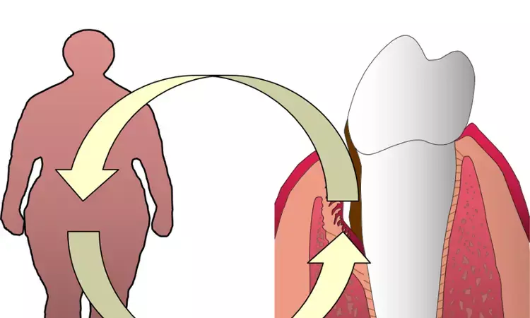 Periodontal Disease may predict Metabolic Syndrome in Women at Prior High Risk for Gestational Diabetes, finds study