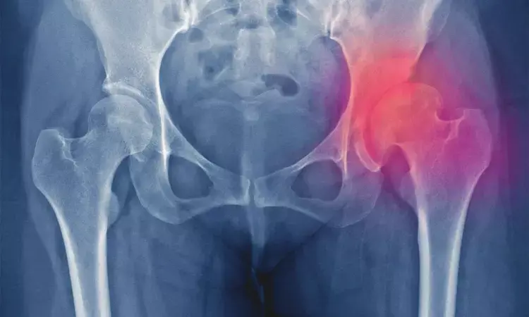 Acetabular dysplasia and the risk of developing hip osteoarthritis