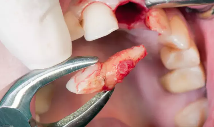 Risk of bleeding after dental extractions rather low among patients on antiplatelet therapy, suggests study