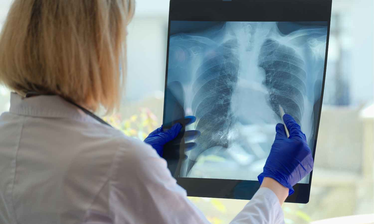 Inhaled Treprostinil Slows Disease Progression in idiopathic pulmonary fibrosis: NEJM