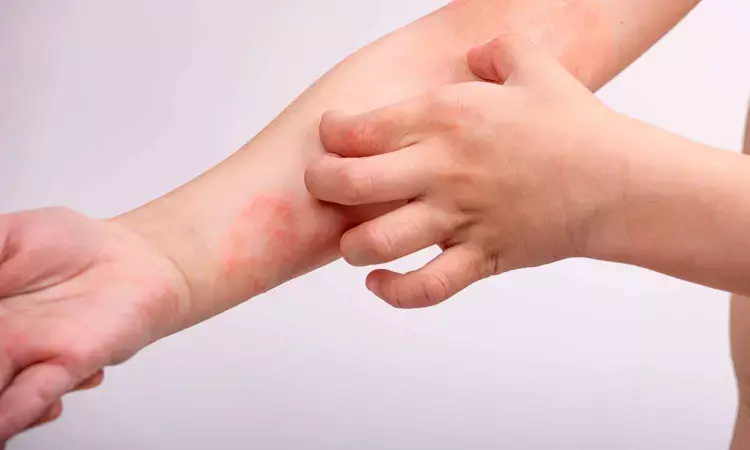 FDA approves tapinarof cream for topical treatment of atopic dermatitis