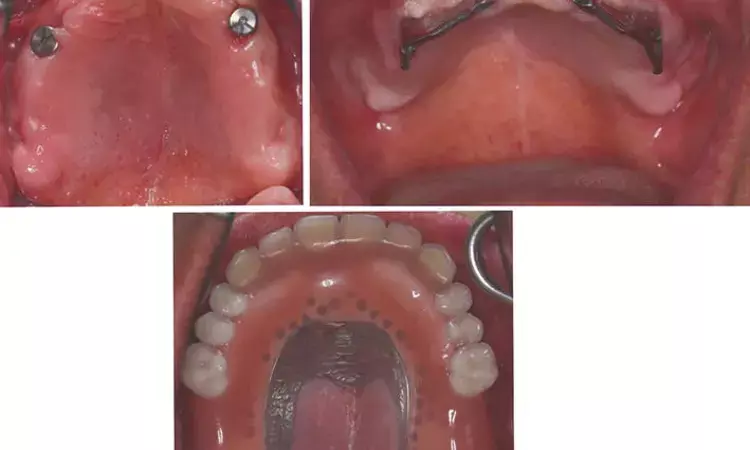 Maxillary four implant retained overdentures tied to high implant and prosthetic survival, oral health QoL: Study