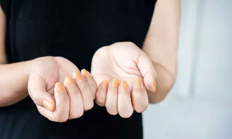 Study identifies genetic cause for yellow nail syndrome