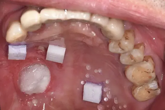 Digital impressions comparable to conventional impressions for complete denture fabrication in maxillary edentulism: Study