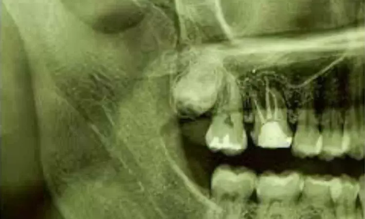 Third molars with completely formed roots suitable donors for replacing missing teeth: Study