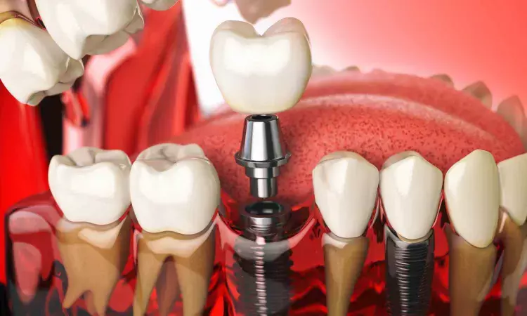 Digital scanning and conventional impressions show comparable accuracy for most fixed prosthodontics, suggests study