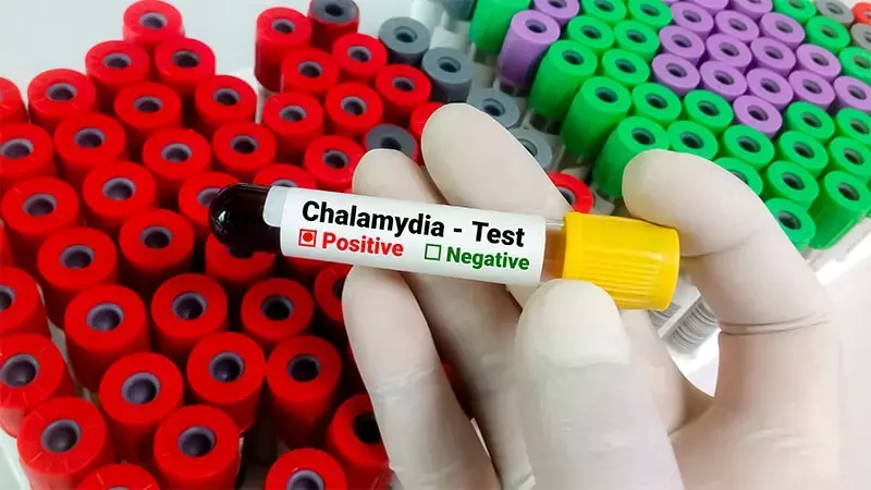 Doxycycline discharge kits significantly improve guideline-directed chlamydia treatment in ED, finds research Doxycycline discharge kits significantly improve guideline-directed chlamydia treatment in ED, finds research