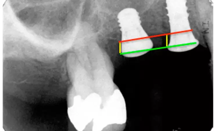 Short implants as good as long implants in posterior maxilla with limited vertical bone height: Study