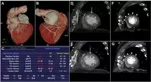 Study supports CT coronary angiography before invasive coronary angiography in patients with previous CABG