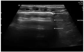 Advanced emphysema tied to high false positivity rate for pneumothorax in point of care ultrasound, finds study