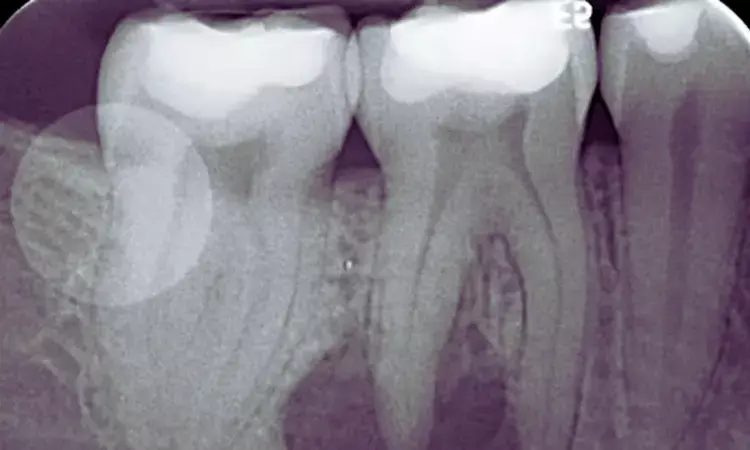 Study Finds Higher Prevalence of Periapical Radiolucent Lesions in Endodontically Treated Teeth with Intraradicular Posts