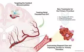 Adjunctive Intra-Arterial Thrombolytics Show Limited Benefits in Stroke Patients Undergoing Mechanical Thrombectomy: JAMA