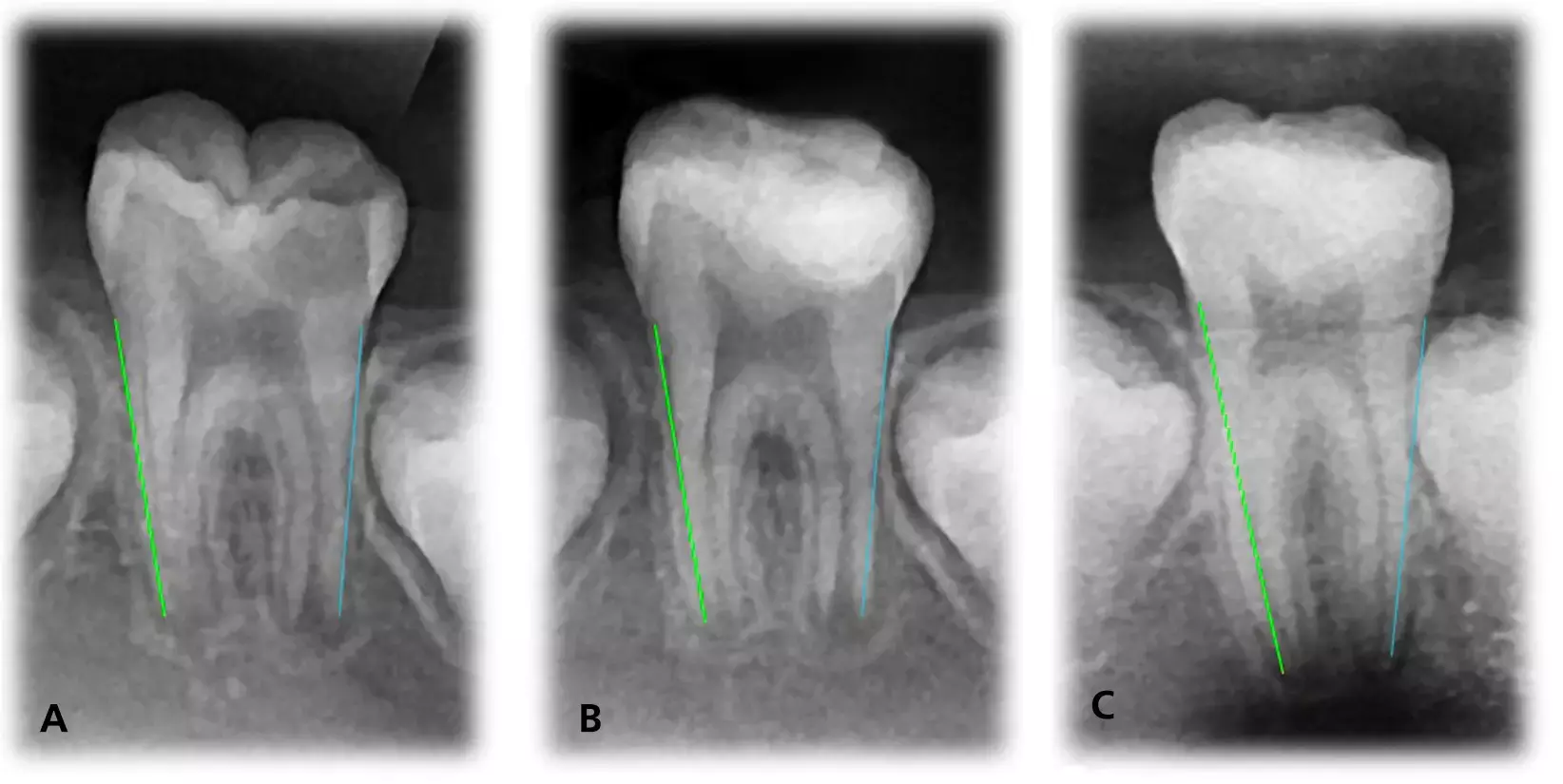 Silver diamine fluoride promising option to mineral trioxide aggregate for  indirect pulp capping of permanent molars: Study