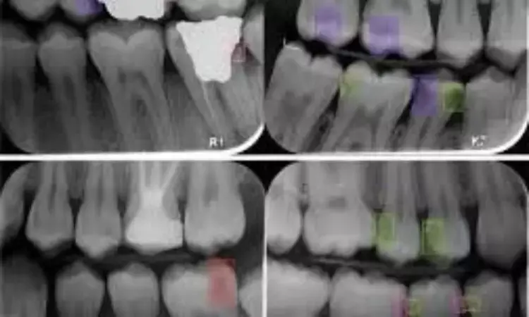 AI-assisted  bitewing radiographs have high accuracy for caries detection, reveals research