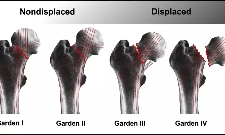 AST/ALT ratio may predict1-year mortality in elderly patients operated for femoral neck fracture: Study