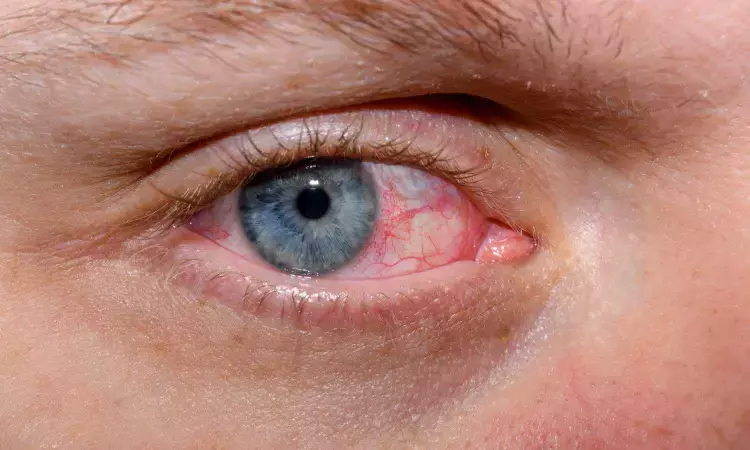 Topical Cyclosporin 0.1% Effective in Treating Pediatric Ocular Inflammation: Study