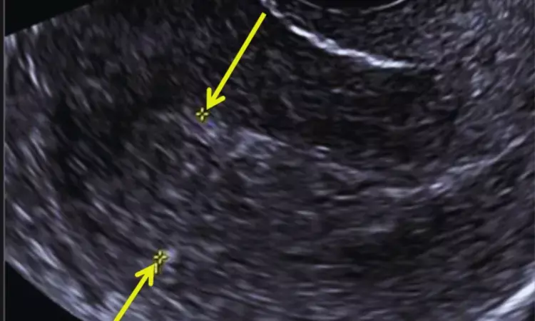 POCUS Promising for Diagnosing Retained Products of Conception, but Caution Advised in Early Pregnancy: Study