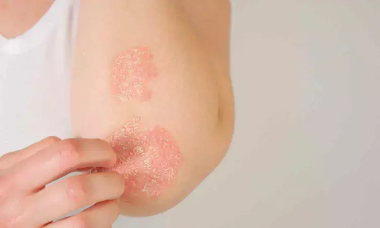 Inflammation may explain stomach problems in psoriasis sufferers,  reveals research