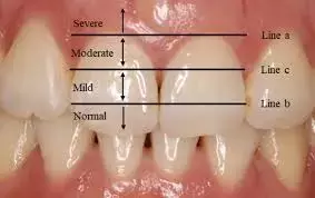 Compared to adults, Adolescents more prone to gingivitis during clear aligner orthodontic treatment: Study