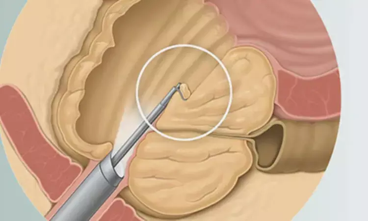 HoLEP Safe and Effective for Elderly Patients with Indwelling Catheters, Study Shows