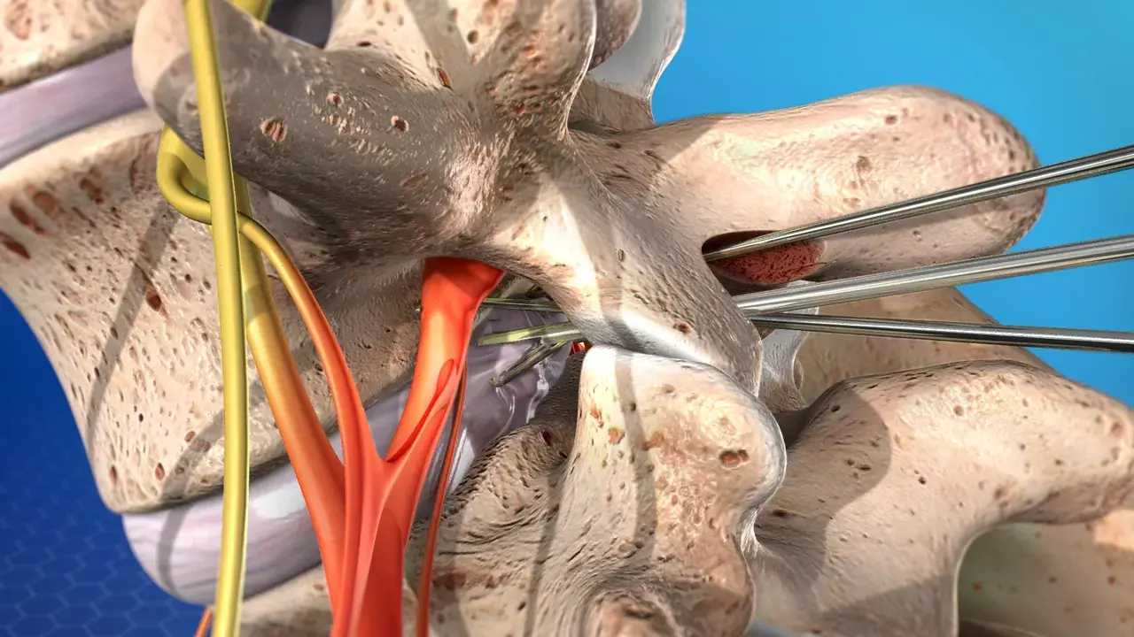 Intraoperative fentanyl infiltration in single-level discectomy statistically reduces early postoperative pain: study