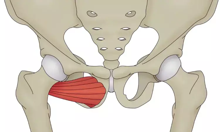 Study Unveils Pelvic Stress Fractures: Rare Complication in Tumour Reconstruction