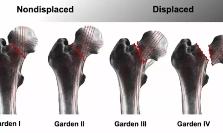 AST/ALT ratio may predict 1-year mortality in elderly patients operated for femoral neck fracture: Study