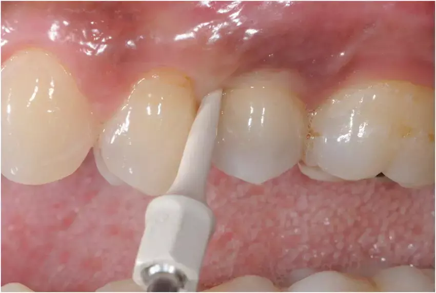 Effective Treatment Options for Peri-Implant Mucositis: Laser vs. Ultrasonic Scaler