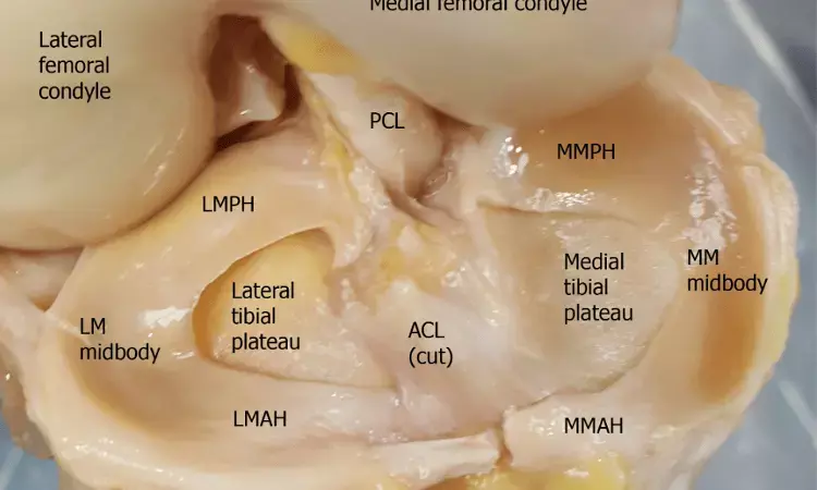 Delta Grip Stitch enhances Fixation Strength in Medial Meniscus Posterior Root Tear Repair: Study