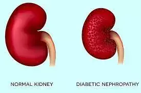 Urinary creatinine Promising Biomarker for Early Detection of DKD in T2DM Patients: Study