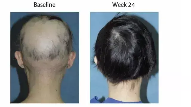 Study Highlights Long-Term Efficacy of Ritlecitinib in Alopecia Areata