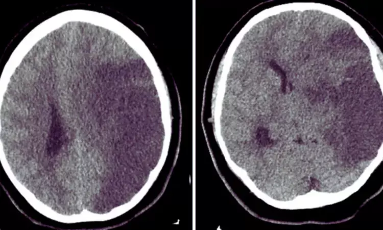 Hyponatremia Tied to Malignant Brain Edema and Poor Outcomes After Mechanical Thrombectomy in Stroke Patients: Study