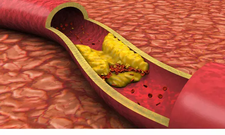 Lerodalcibep Matches Evolocumab in LDL-C Reduction for HoFH: Lancet