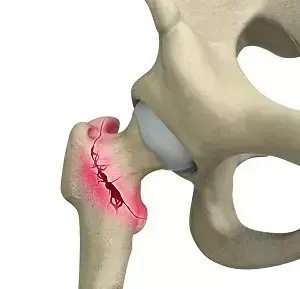 Integrated Dual Lag Screws have Higher Reoperation Rates for fixation failure for intertrochanteric femoral fractures: Study