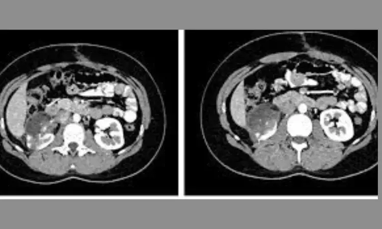 Among pediatric renal tumor patients, Robot-assisted resection feasible, safe with less surgical trauma: Study