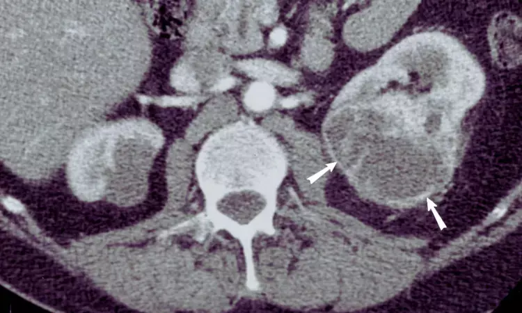 AI Helps Predict Malignancy and Aggressiveness of Renal Masses Using CT Scans: Study