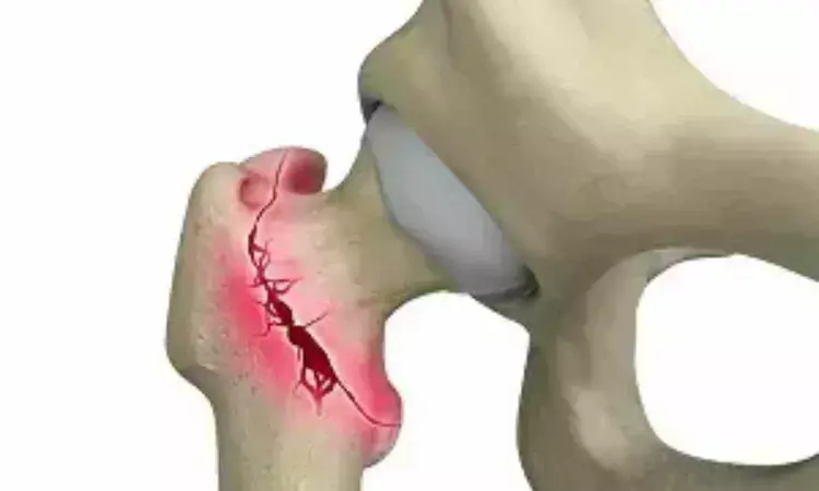 Integrated Dual Lag Screws have Higher Reoperation Rates for fixation failure for intertrochanteric femoral fractures: Study