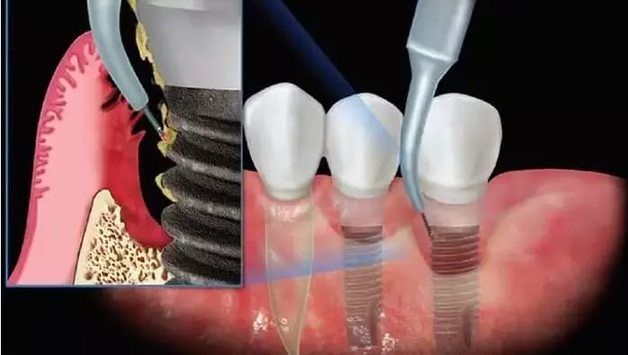 Are Robotic-Assisted Dental Implants more Accurate Than Freehand Surgery?